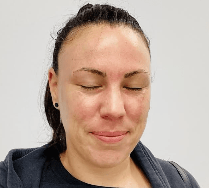 Post-Hydrafacial treatment skin condition