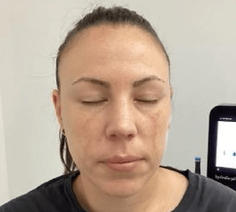 Pre-Hydrafacial treatment skin condition